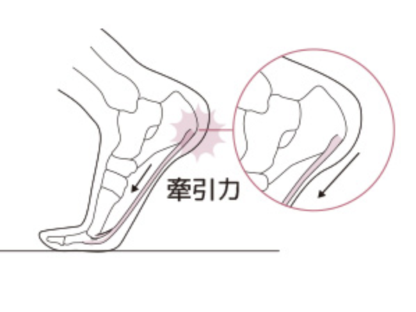 足底腱膜炎の図解